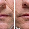 1 Stück Radiesse Hautfüller 1,5 ml Injektion/Spritze, wie man Falten schnell aus dem Gesicht entfernt, am besten zur Beseitigung von Alterserscheinungen wie ung