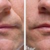 1 Stück Radiesse Hautfüller 1,5 ml Injektion/Spritze, wie man Falten im Gesicht auf natürliche Weise reduziert, beste Injektion zur Linderung von Alterserschein
